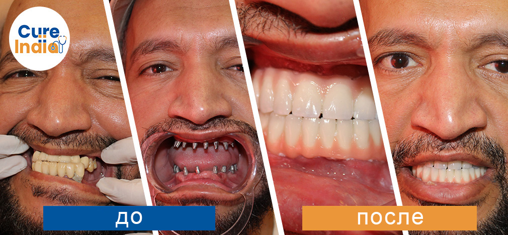 Все на 4 Имплантация зубов в индии - Все на 4 Процедура имплантации